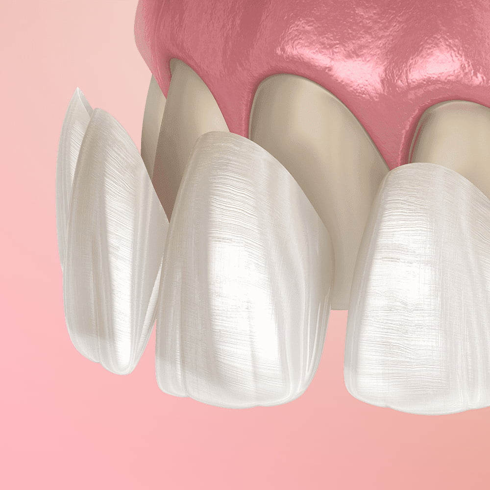 carillas-dentales.jpg